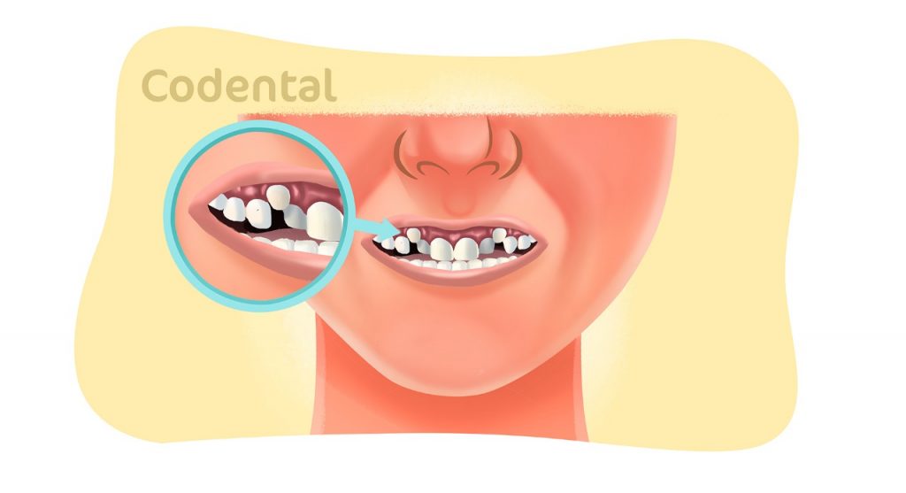 Dente encavalado conheça as principais causas e muito mais