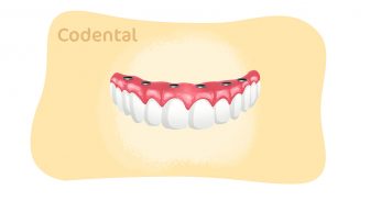 Dentadura fixa: tudo que você precisa saber