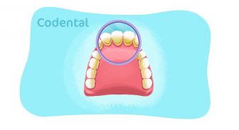 Cálculo dental: saiba tudo sobre essa condição odontológica