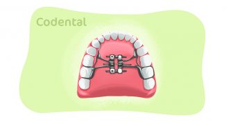 Saiba tudo sobre expansor palatino