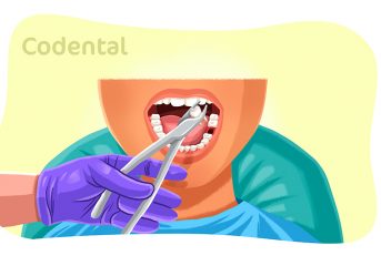 Extração de dente