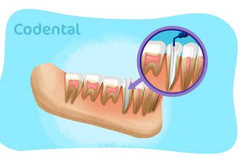 Medicação intracanal