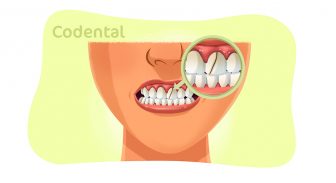 Dente trincado: conheça suas causas e tratamentos