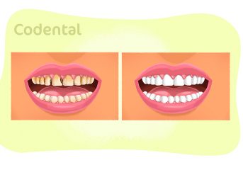 Restauração com resina nos dentes da frente