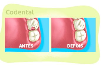 Restauração de dente