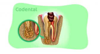 Lesão periapical: saiba tudo sobre