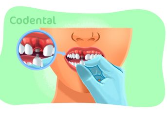 Sintomas de infecção no implante dentário