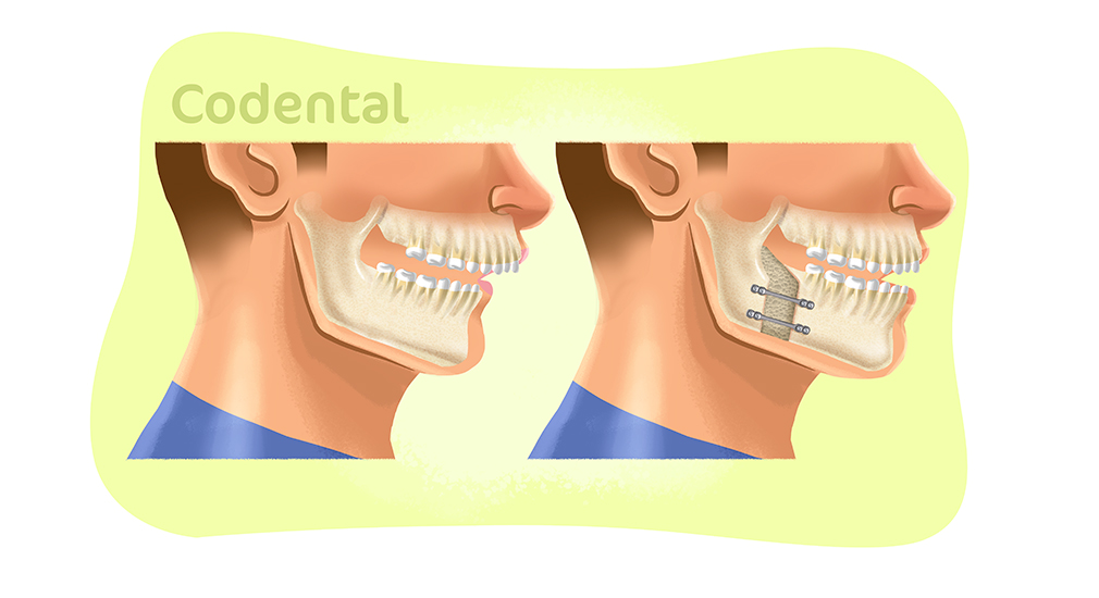 Cirurgia para aumentar ângulo da mandíbula – O que é, suas causas e  soluções.