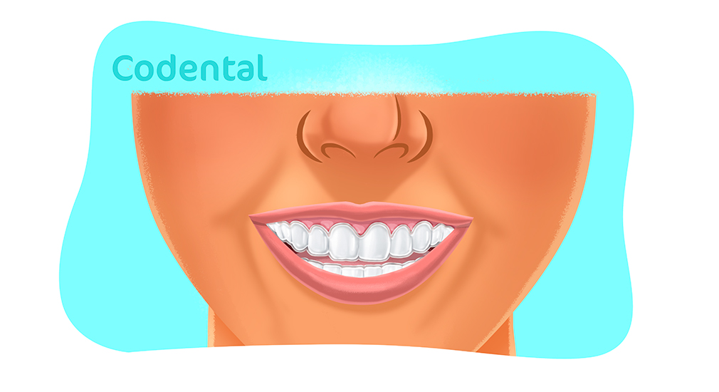 Entenda como funciona o alinhador dental transparente 