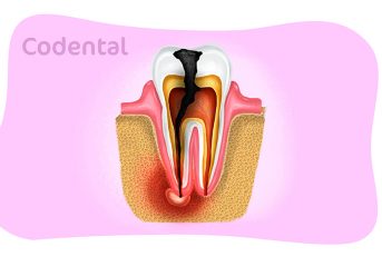 Dente infeccionado