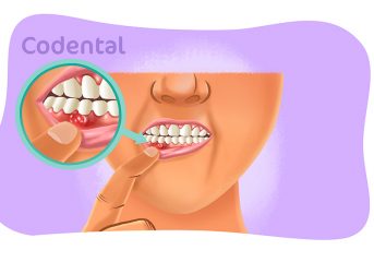 Fistula dental