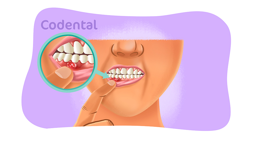 Fistula dental
