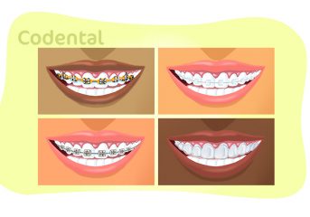 Tipos de aparelhos ortodônticos