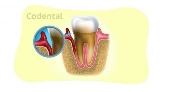 Bolsa periodontal: tudo que você precisa saber!