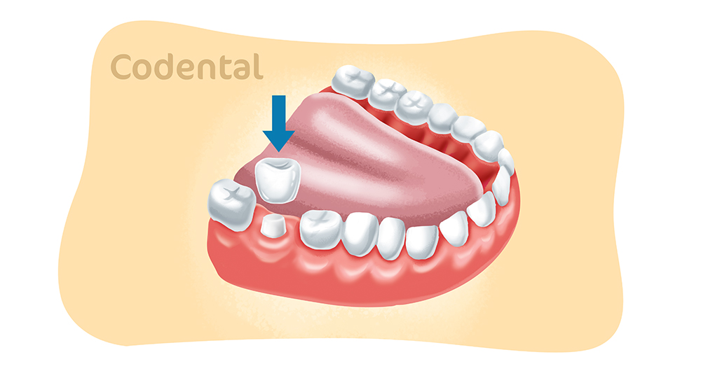 coroa dentária