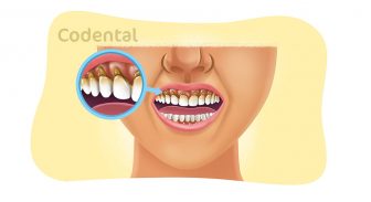 Abfração dental: um guia completo sobre esse problema!