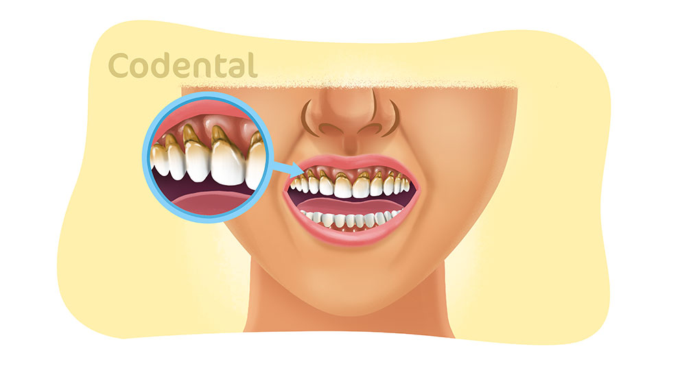 abfração dental