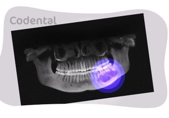 Ameloblastoma