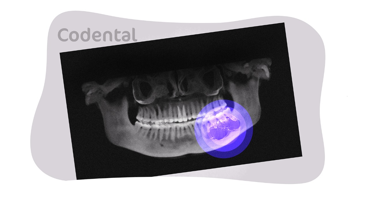 Ameloblastoma