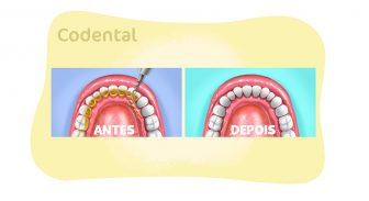 como retirar tartaro dos dentes