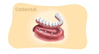 overdenture