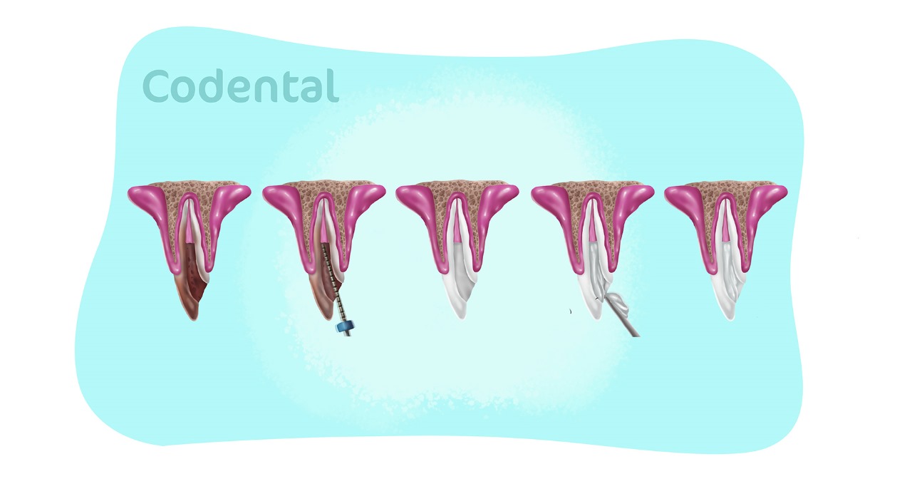 clareamento dentário interno