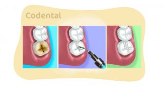 Selante dentário: um guia completo para dentistas