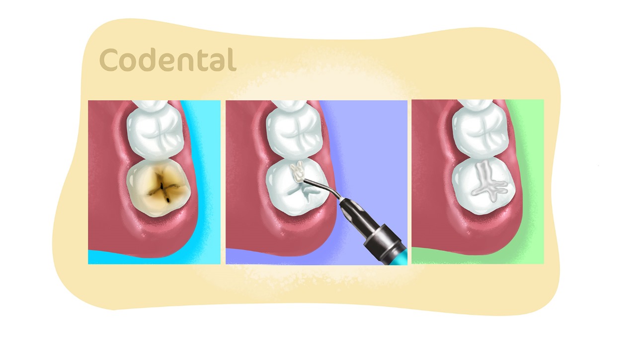 selante dentário