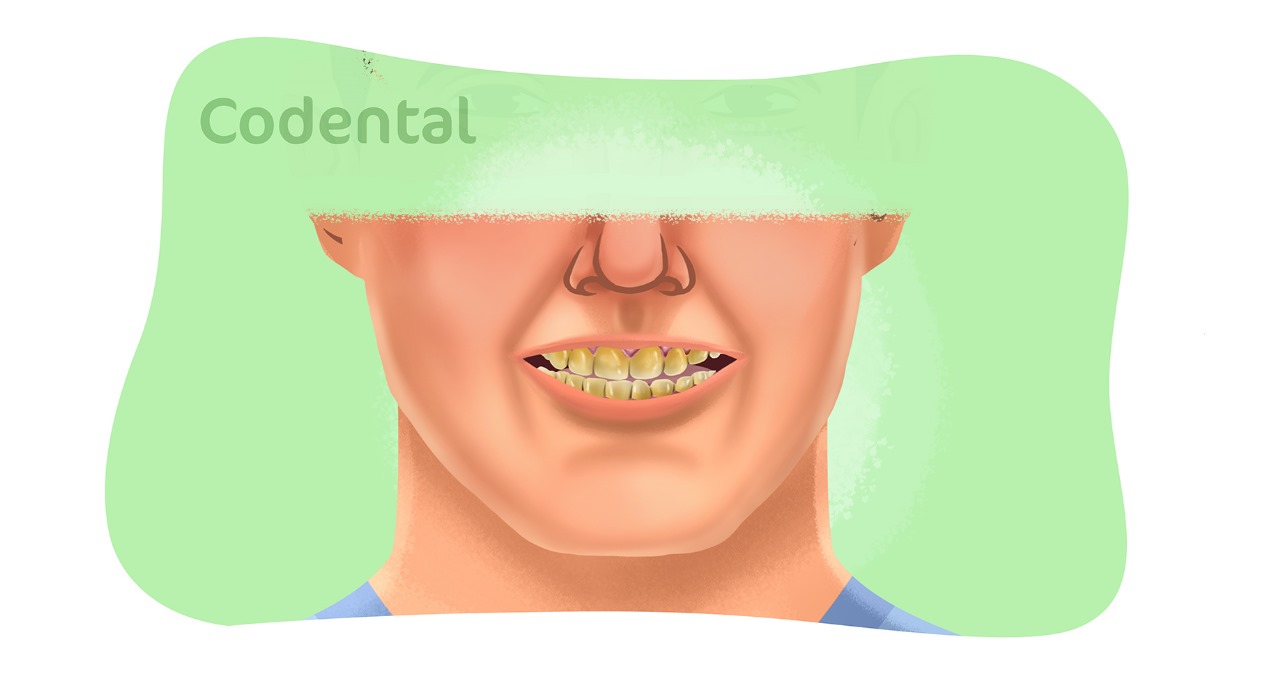 dentes amarelados