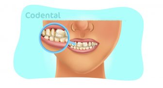 Falta de cálcio nos dentes