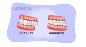 Overjet e overbite