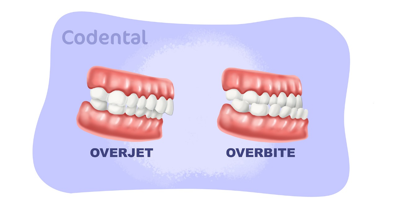 Overjet e overbite